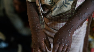 Third of Burundi mpox cases in children under five: UN