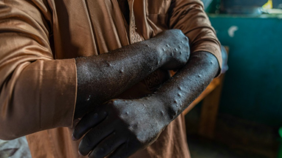 RDC: la vaccination contre le mpox commence samedi à Goma