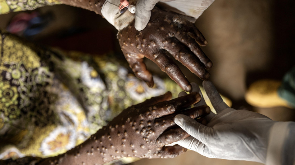 Mpox, -13% di casi a novembre ma virus resiste in Africa